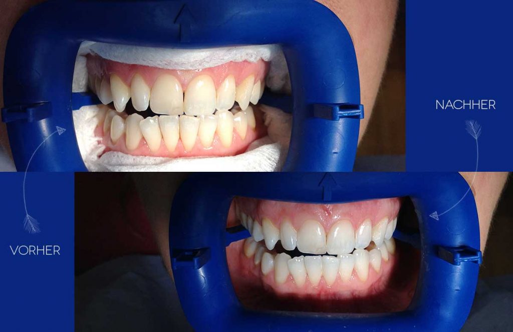 Endlich weiße Zähne - Meine zweite Bleaching Behandlung - Vickyliebtdich