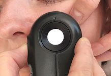 Muttermal Entfernung im Gesicht – Meine Erfahrung bei The Aesthetics Muttermal-Entfernung-im-Gesicht-Meine-Erfahrung-bei-The-Aesthetics-dermalight