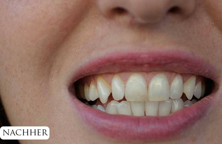 Zähne-bleachen-endlich-weiße-Zähne-ansicht-von-vorne-nach-dem-bleachen