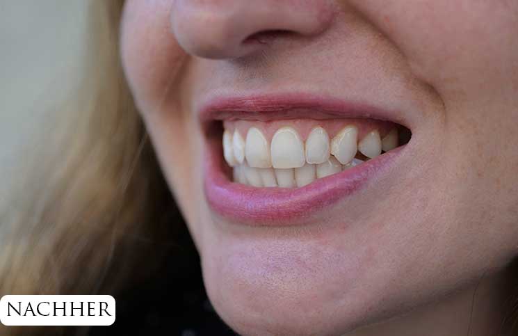 Zähne-bleachen-endlich-weiße-Zähne-nach-dem-aufhellen
