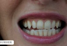 Zähne bleachen – endlich weiße Zähne Zähne-bleachen-endlich-weiße-Zähne-vor-dem-bleachen-gelbe-zahnzwischenräume