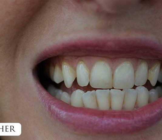 Zähne bleachen – endlich weiße Zähne Zähne-bleachen-endlich-weiße-Zähne-vor-dem-bleachen-gelbe-zahnzwischenräume