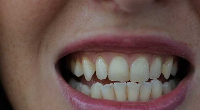 Zähne bleachen – endlich weiße Zähne Zähne-bleachen-endlich-weiße-Zähne-vor-dem-bleachen-gelbe-zahnzwischenräume