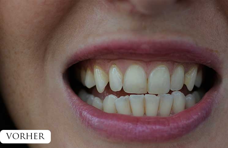 Zähne-bleachen-endlich-weiße-Zähne-vor-dem-bleachen-gelbe-zahnzwischenräume